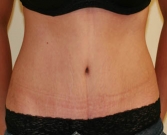 Feel Beautiful - Tummy Tuck Case 26 - After Photo
